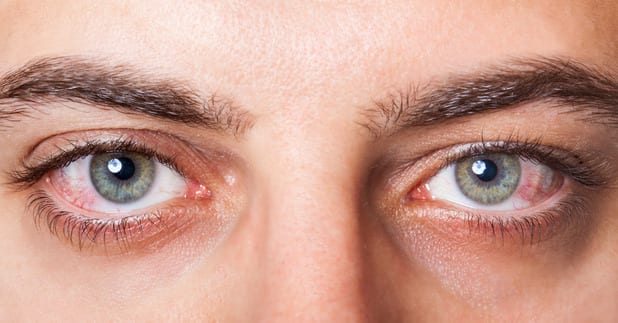 emergencies pinkred eyes emergencies pinkred eyes